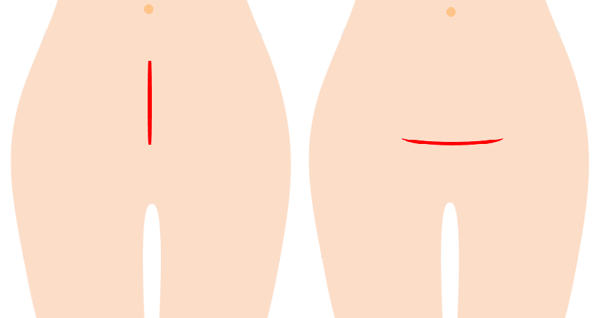 帝王切開の傷あとを残さない 妊娠中からできる予防策とケア知識 切迫早産 安静ママの応援サイト